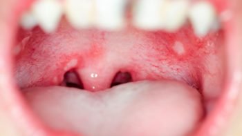 giang mai hau hong 1