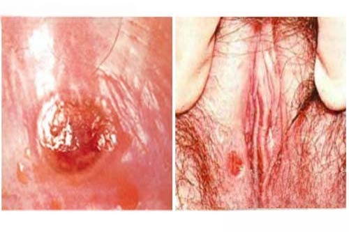 giang mai vung kin nu