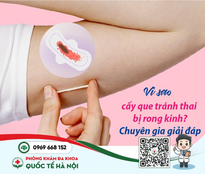 cấy que tránh thai bị rong kinh phải làm sao