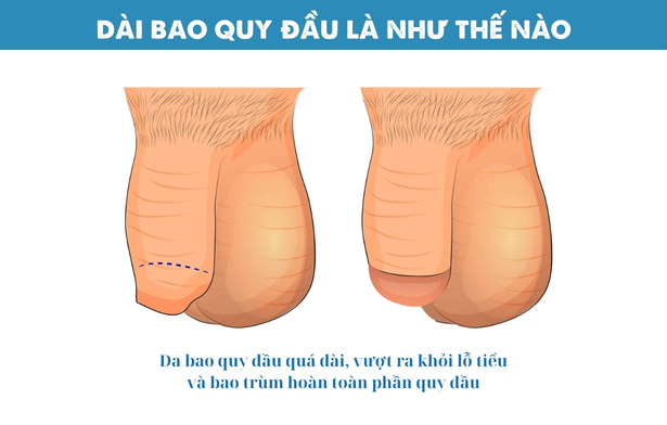 Làm sao nhận biết bao quy đầu bị dài?