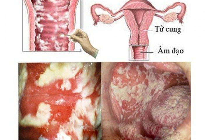 SAU SINH BỊ VIÊM ÂM ĐẠO PHẢI LÀM SAO? 2 viem am dao sau sinh