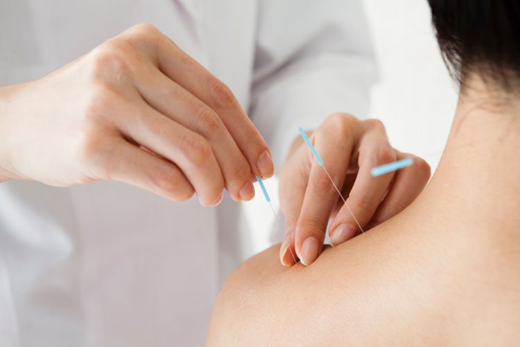 Châm cứu dưỡng sinh đông y đả thông kinh lạc