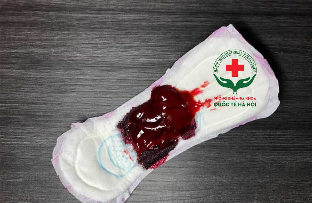 SO SÁNH THUỐC MISOPROSTOL STADA VÀ MIFEPRISTONE 3 ra mau den sau khi pha thai bang thuoc 2