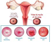 chua-viem-lo-tuyen-co-tu-cung-o-dau-tot